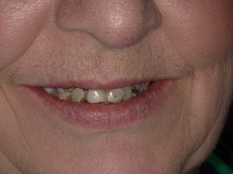 Before Image: All on X - front