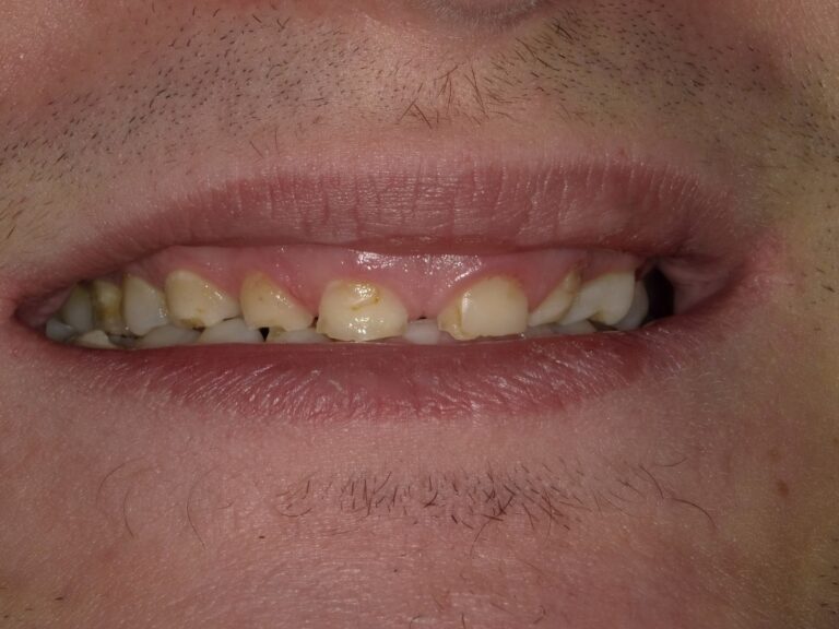 Before Image: Full Arch Crowns - front