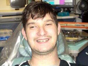 Before Image: Full Arch Crowns