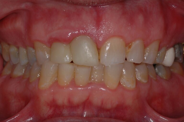 Before Image: Full Arch Crowns - front