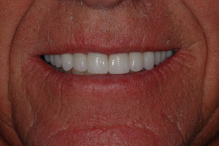 After Image: Full Arch Crowns - front