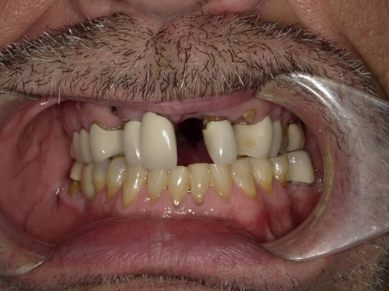 Before Image: Implant Supported Bridge - front