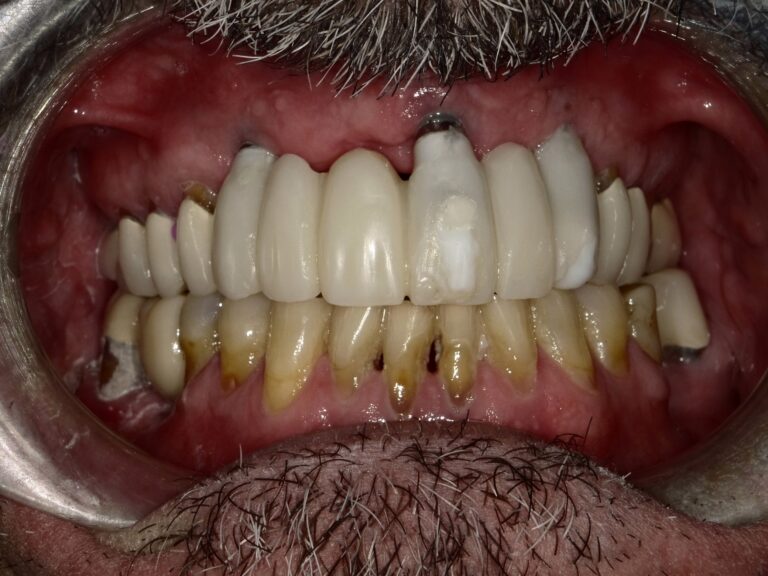 After Image: Implant Supported Bridge - front