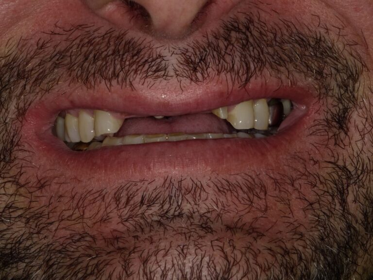 Before Image: Crowns - front