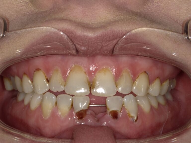 Before Image: Full Arch Crowns - front