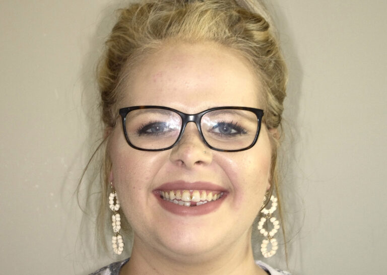 Before Image: Full Arch Crowns - front
