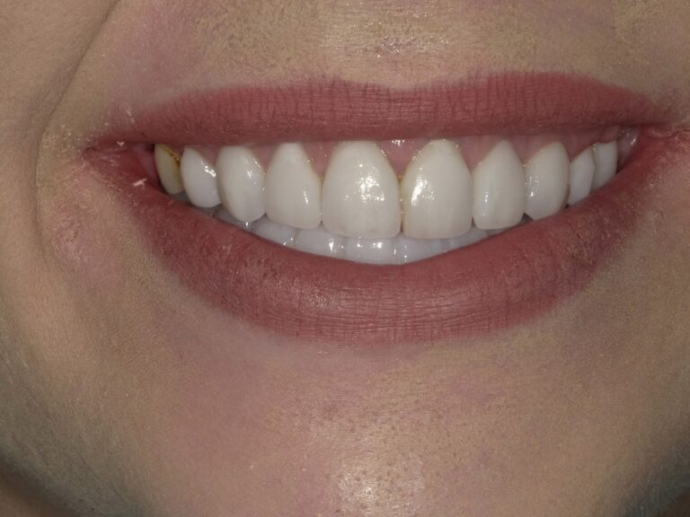 After Image: Full Arch Crowns - front