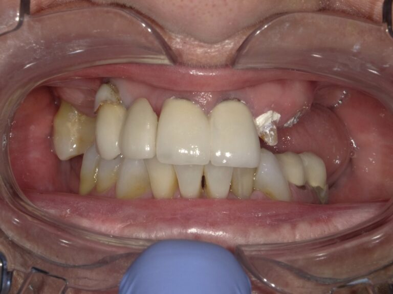 Before Image: All on X - front