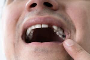 Man with missing teeth in Williamson County