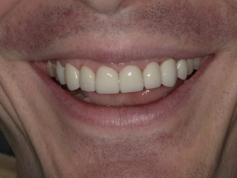 After Image: Upper Full Arch Crowns - front