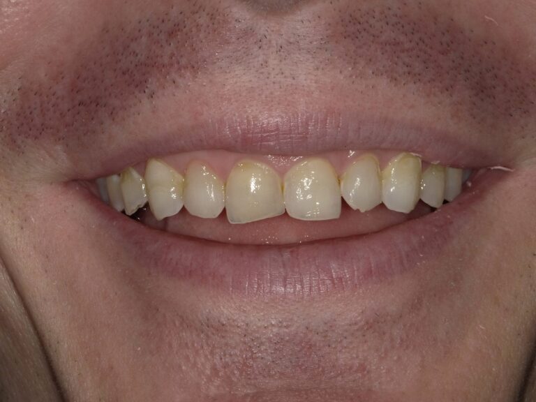Before Image: Upper Full Arch Crowns - front